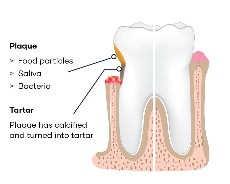 Dental disease teeth Plaque food particles, saliva and bacteria Tartar Plaque has been calcified and turned into tartar